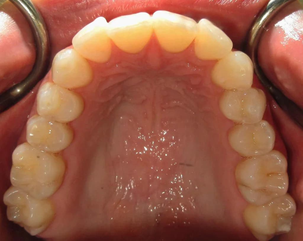 Clear aligners Before and After - Dental Salon, before photo