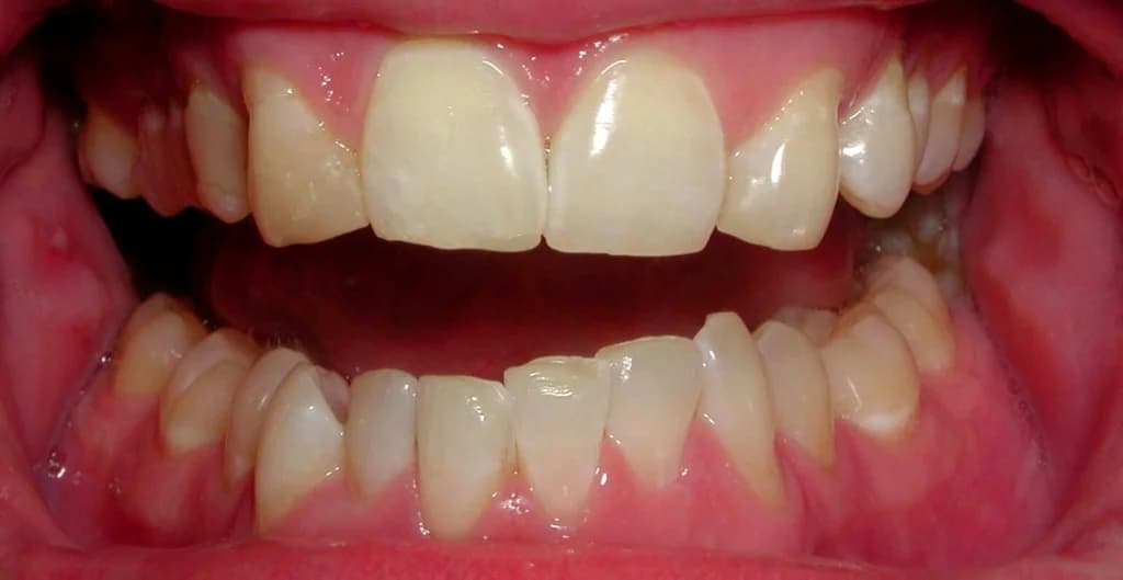 Clear aligners and veneers Before and After - Dental Salon, before photo