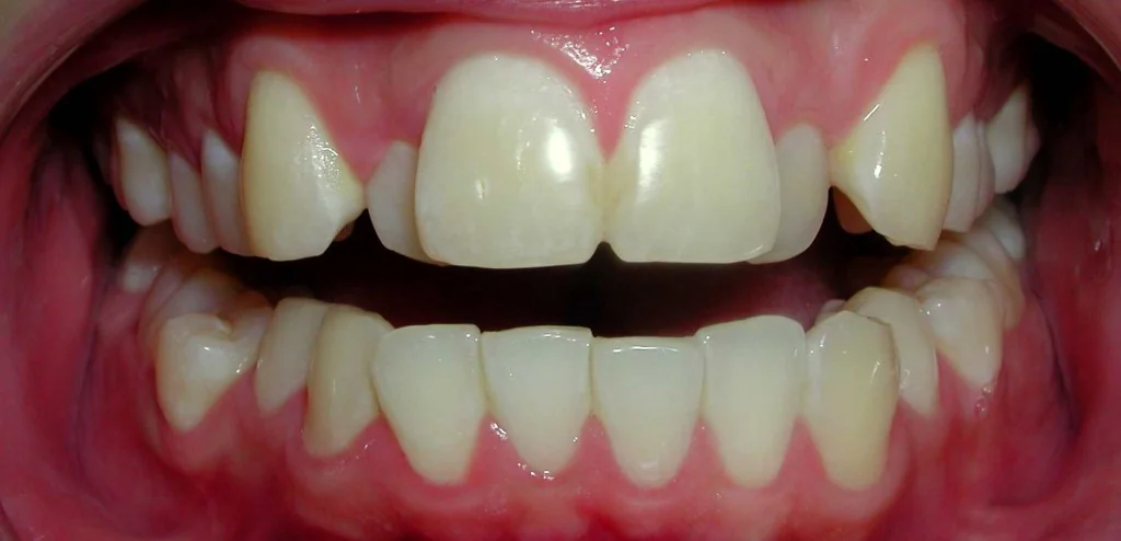 Clear aligners Before and After - Dental Salon, before photo