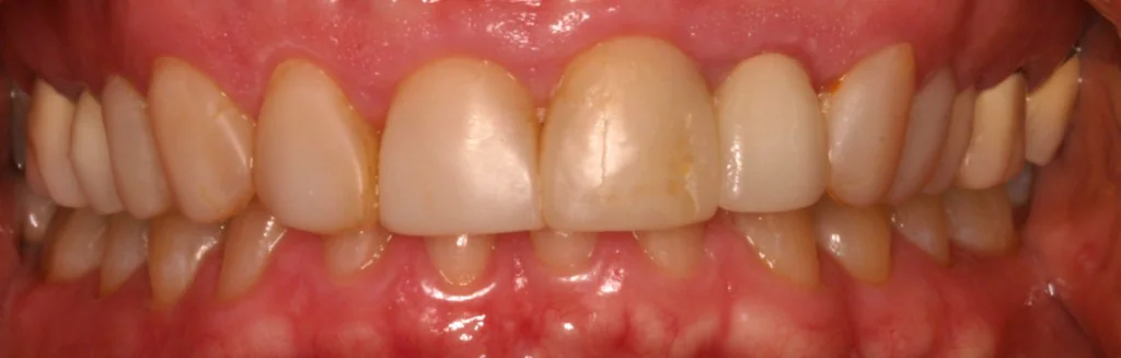 Smile design Before and After - Dental Salon, before photo