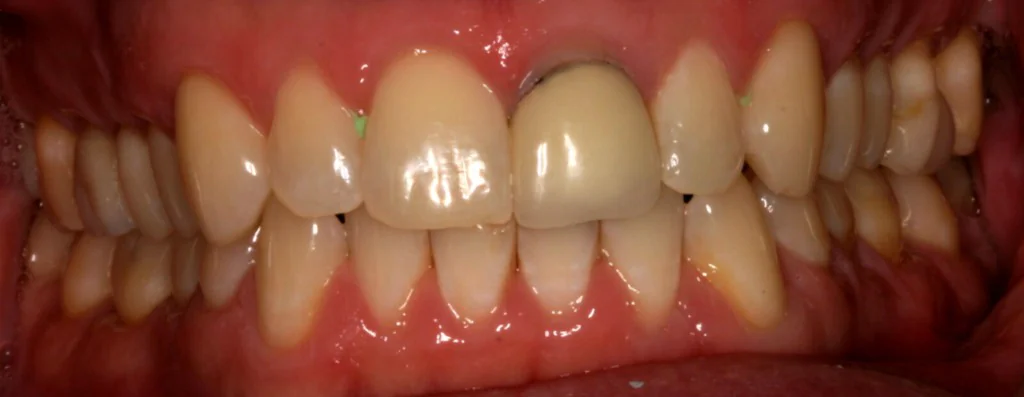 Smile design Before and After - Dental Salon, before photo