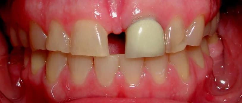 Porcelain crowns & veneers Before and After - Dental Salon, before photo