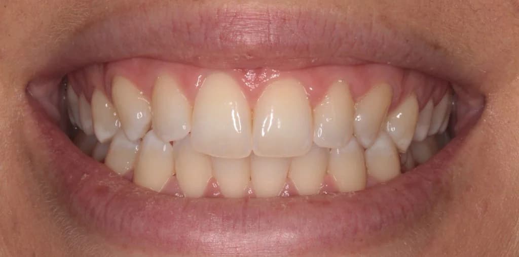 Professional whitening Before and After - Dental Salon, before photo